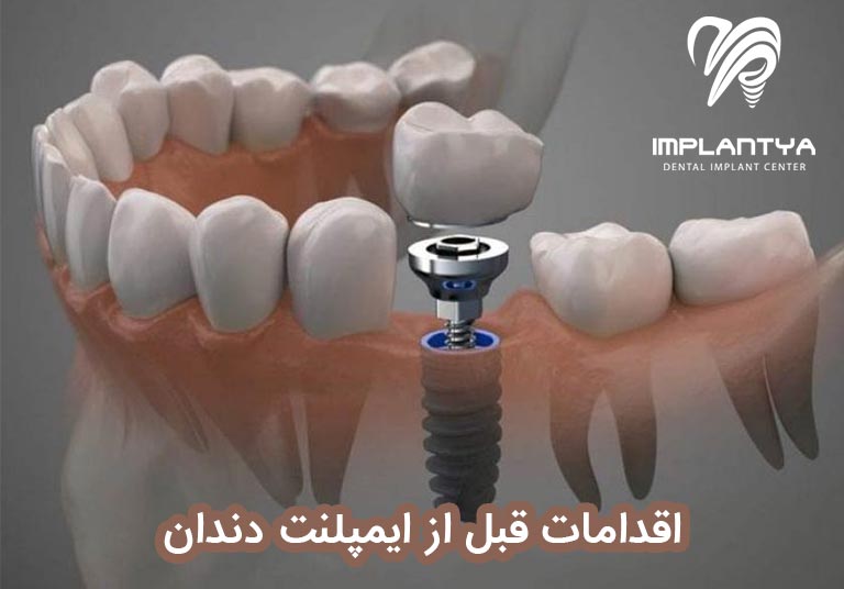 اقدامات قبل از ایمپلنت دندان