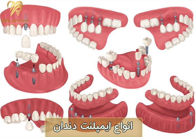 انواع ایمپلنت دندان - راز جراحی